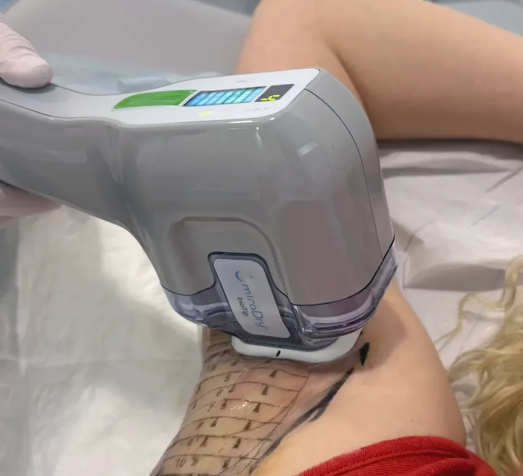 Die MiraDry Behandlung in Wien bei Dr. Gmelch ist dank örtlicher Betäubung schmerzfrei
